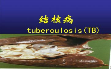结核病防治讲话稿6篇